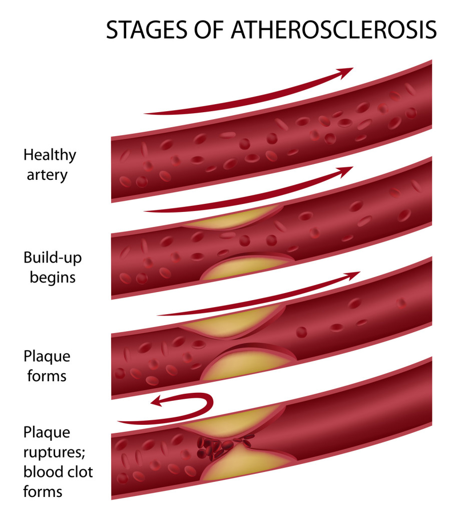 Artery damage from cholesterol